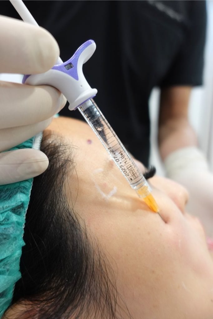 以喬雅登 Volift 搭配細鈍針填補臉頰凹陷的施打過程