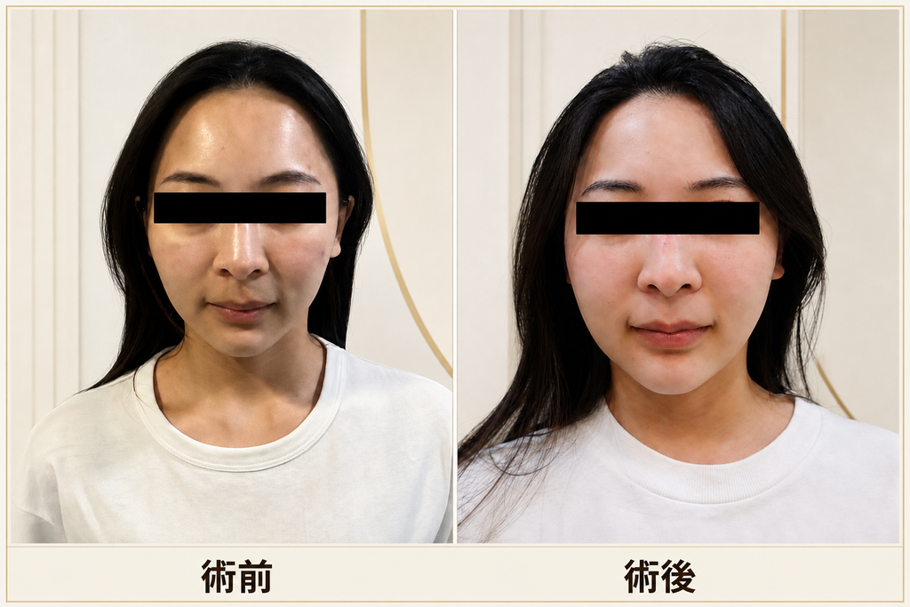 木偶紋改善案例