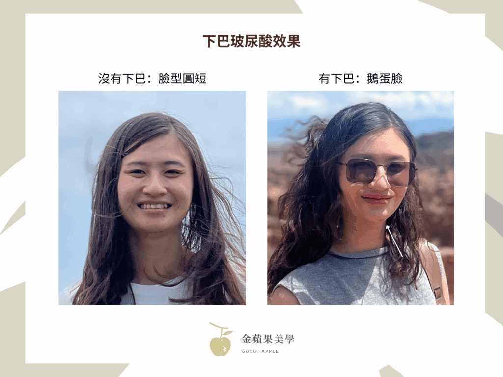 喬雅登下巴