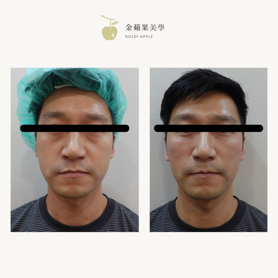 眼袋型淚溝男性案例：施打淚溝玻尿酸術前術後正面對比照