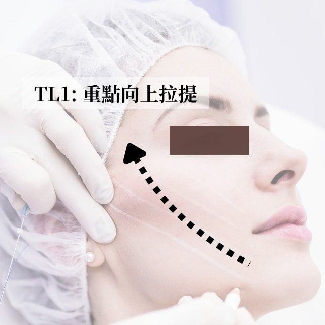 TL1重點向上拉提示意圖：箭頭標示臉頰埋線向上拉提方向