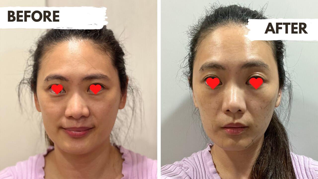 電波拉提前後對照：標示BEFORE與AFTER的女性正面照片