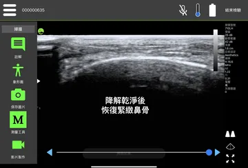 超音波影像標註「降解乾淨後恢復緊緻鼻骨」