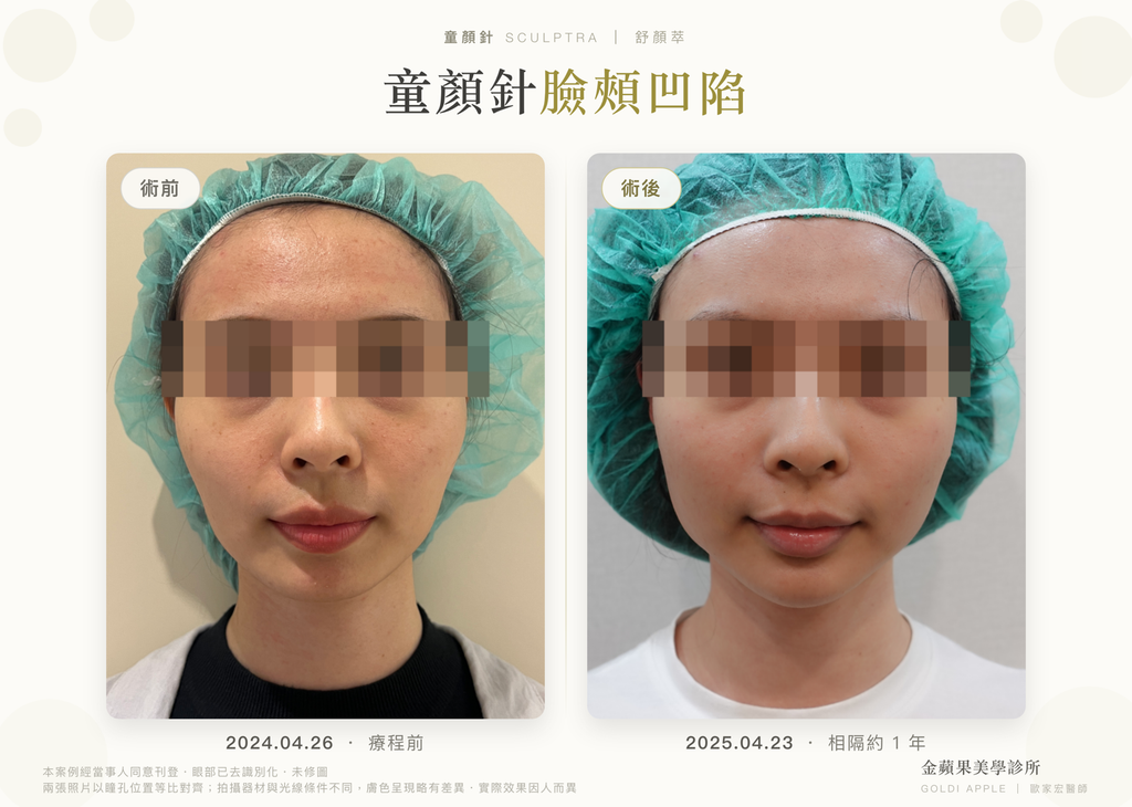 童顏針臉頰凹陷
