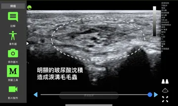 超音波影像標註「明顯的玻尿酸沈積造成淚溝毛毛蟲」，虛線圈出團塊範圍