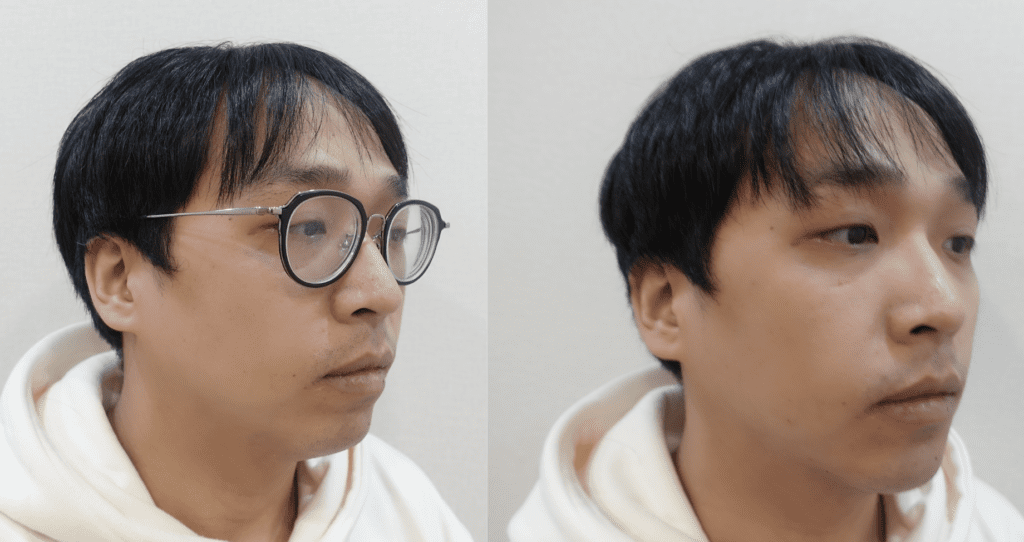男生下巴玻尿酸