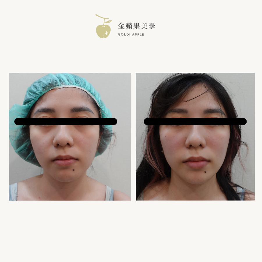 單純凹陷型淚溝施打淚溝玻尿酸的術前術後正面對比照