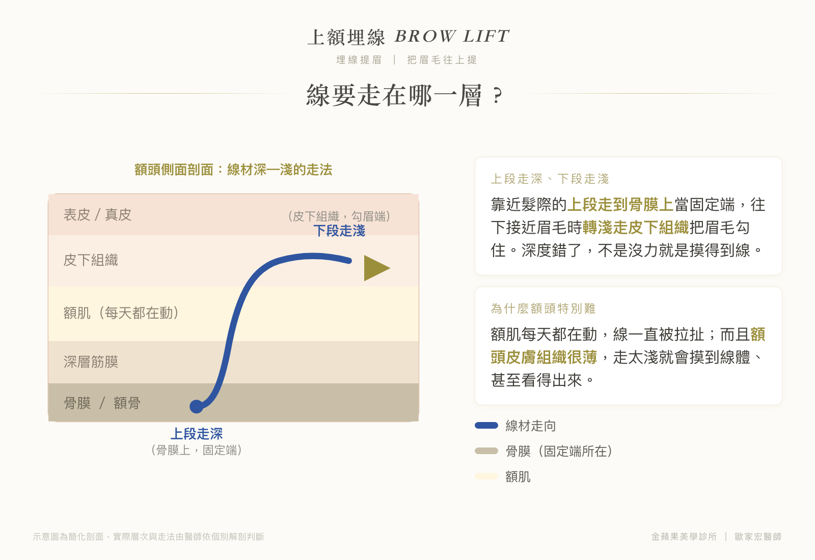 上額埋線走線層次剖面圖：上段走深至骨膜上當固定端，下段轉淺走皮下組織勾住眉毛