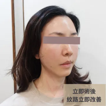 埋線立即術後斜側臉照，標註「紋路立即改善」