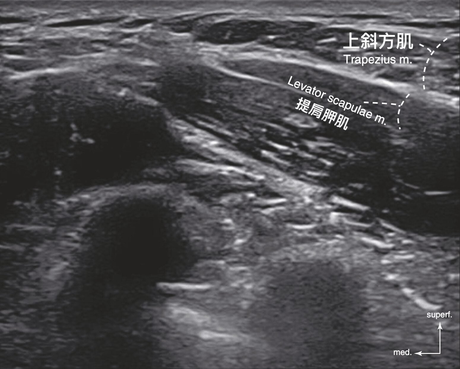 肩頸超音波影像：標示上斜方肌（Trapezius）與提肩胛肌（Levator scapulae）位置