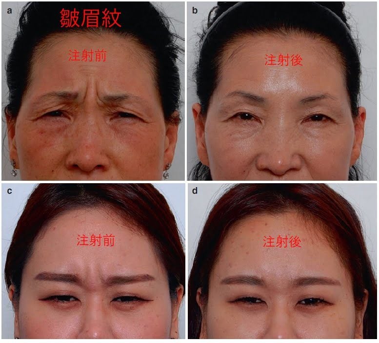 皺眉紋肉毒動態紋除皺四格對比圖：標示注射前與注射後