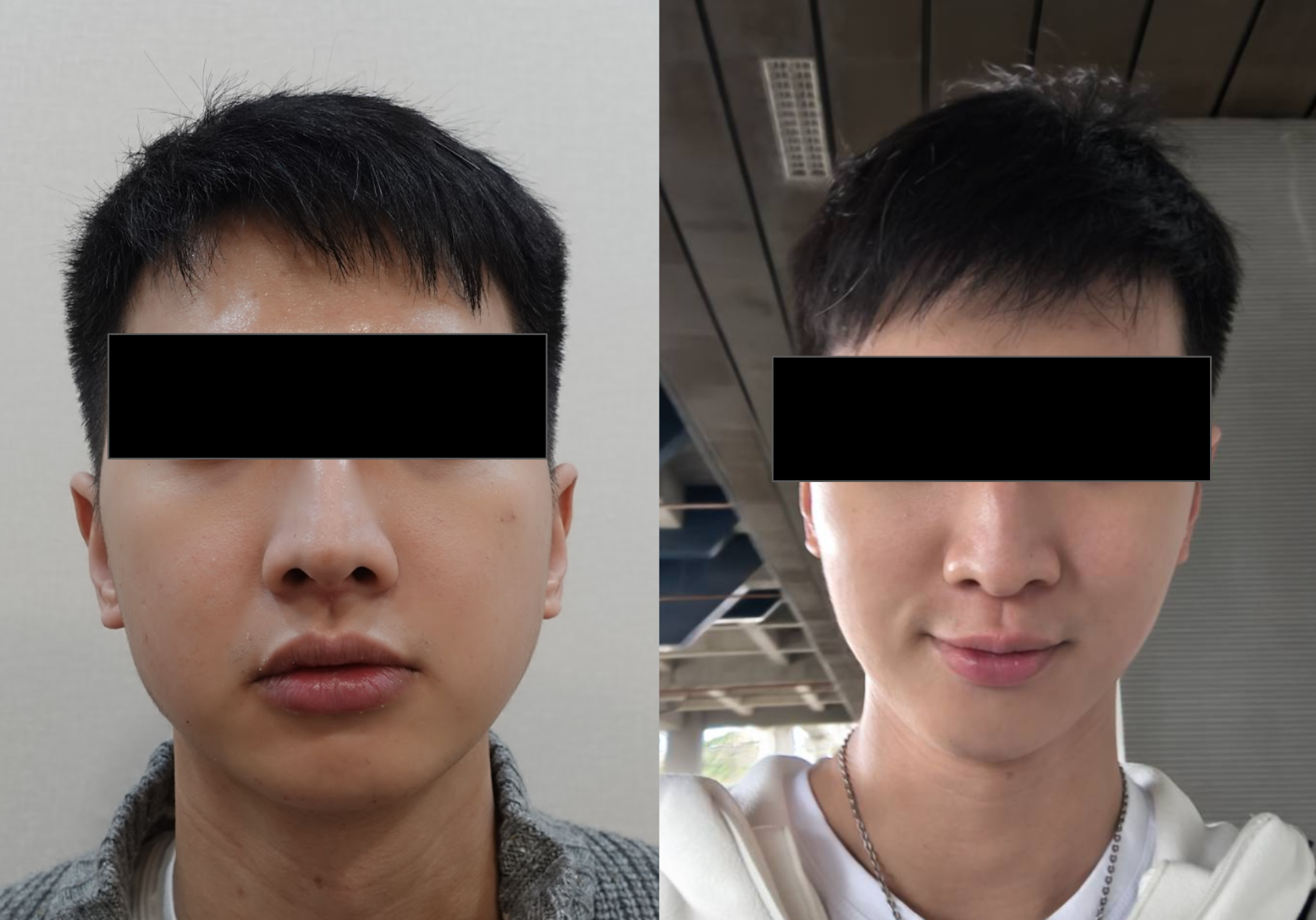 男性施打咀嚼肌肉毒前後正面對比照，眼部已遮蔽