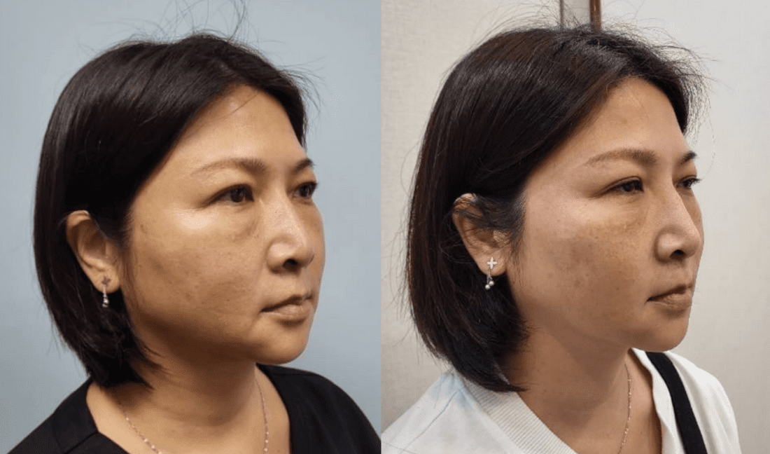 無痕筋膜拉提案例 1：神力拉提埋線改善嘴邊肉與木偶紋