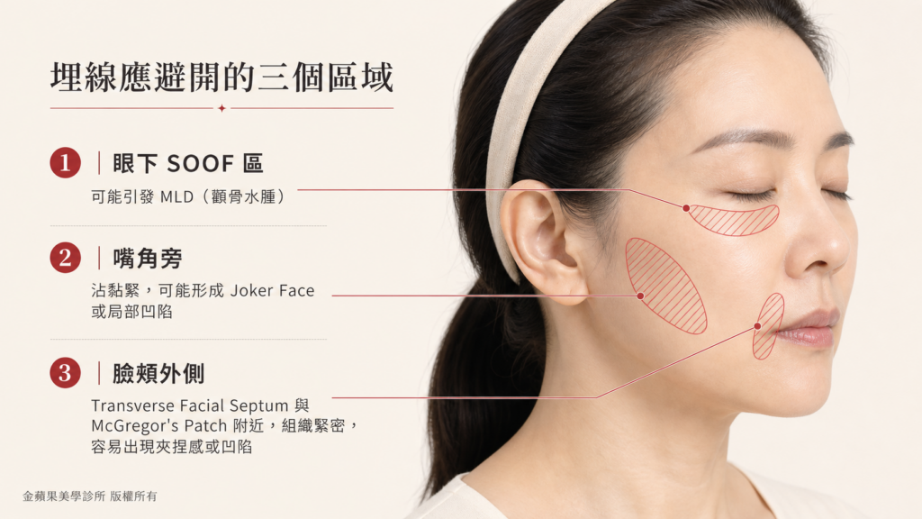 無痕筋膜拉提應避開的三個區域示意圖：眼下 SOOF 區、嘴角旁三角區與咬肌區