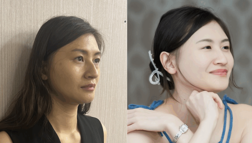 定期音波拉提保養維持下顎線的女性臉部對照照片