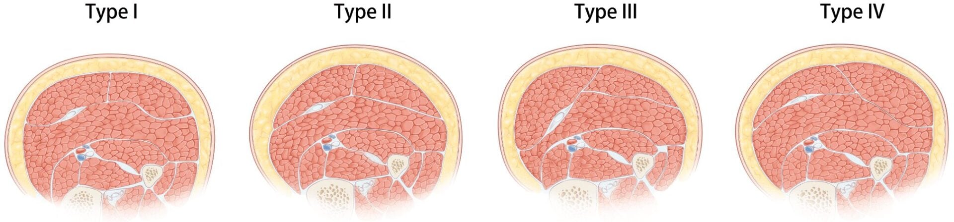 小腿肌肉分型剖面示意圖：Type I至Type IV四種腓腸肌型態