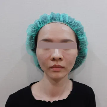 38歲女性施打玻尿酸後淚溝形成毛毛蟲的正面案例照