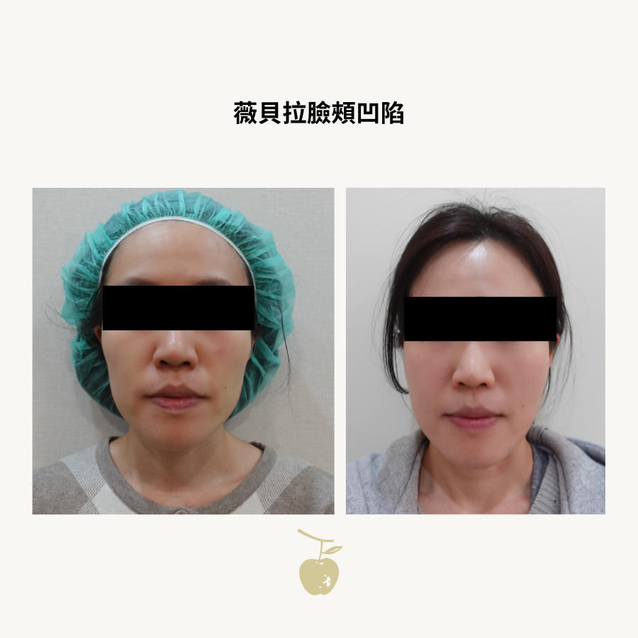 薇貝拉臉頰凹陷兩瓶施打一年後追蹤正面對照