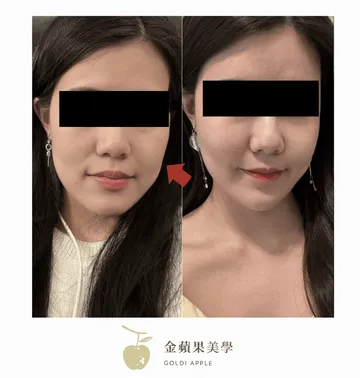 下垂型臉頰凹陷埋線拉提術前術後斜側臉對照，箭頭標示臉頰部位