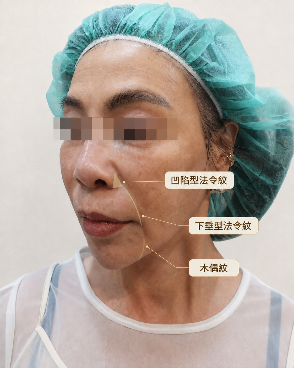 法令紋 鼻基底凹陷區別