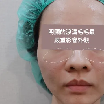 臉部特寫標註「明顯的淚溝毛毛蟲嚴重影響外觀」，圈出眼下玻尿酸凸起位置