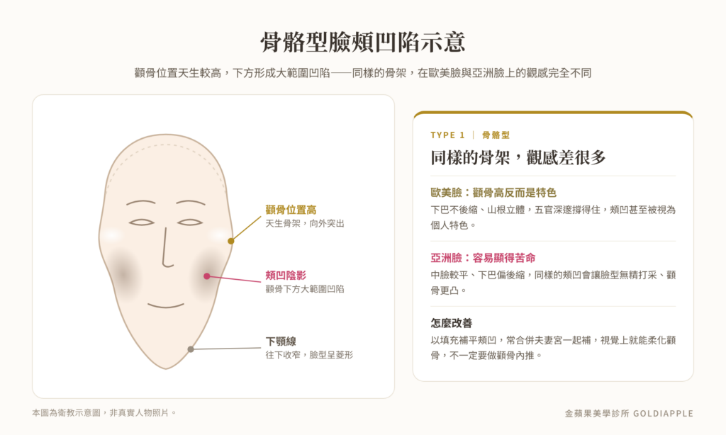 骨骼型臉頰凹陷示意圖：顴骨位置高、顴骨下方大範圍凹陷陰影、下顎線收窄呈菱形臉