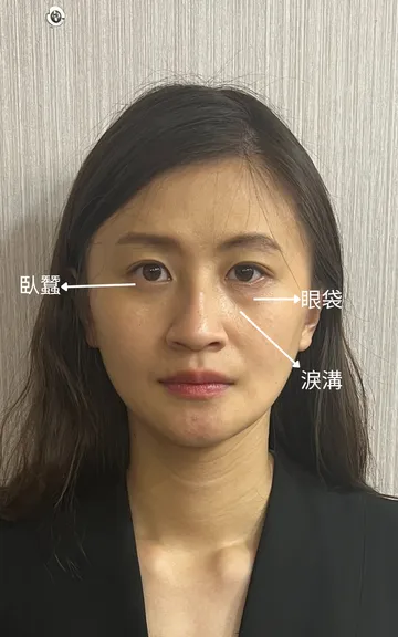 淚溝是什麼