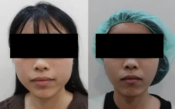 女性施打咀嚼肌肉毒案例正面對比照