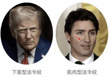 法令紋類型示意：左為下垂型法令紋，右為肌肉型法令紋