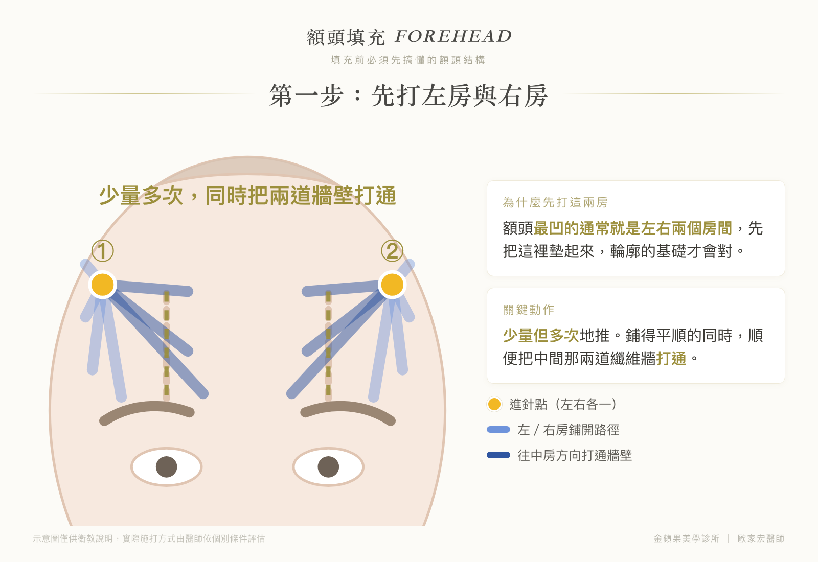 額頭填充第一步示意圖：左右兩個進針點，少量多次鋪開左房與右房，同時打通兩道纖維牆壁