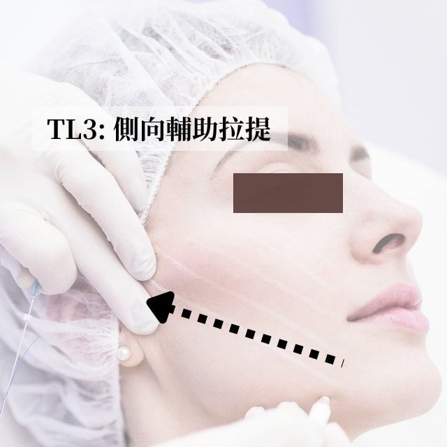 TL3側向輔助拉提示意圖：箭頭標示臉頰埋線側向拉提方向