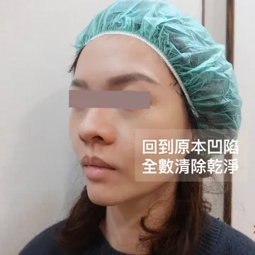 女性側臉照標註「回到原本凹陷、全數清除乾淨」，顯示玻尿酸降解後的淚溝狀態