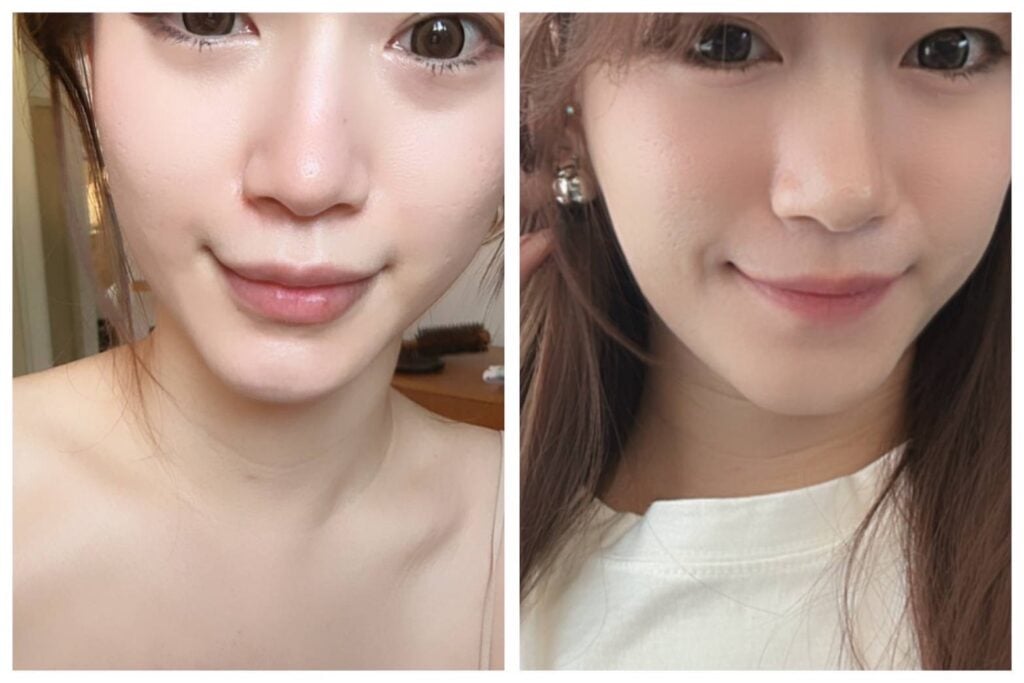 喬雅登玻尿酸真實案例分享：年輕女性臉部特寫左右對照